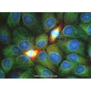  Immunofluorescent LM of squamous carcinoma cells 