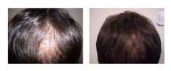 iGrow laser stimulator helmet dome comb hair regrowth growth stop 