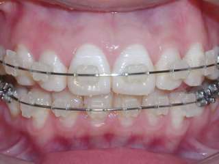 Dental A22 Orthodontics Roth Ceramic Bracket Braces  